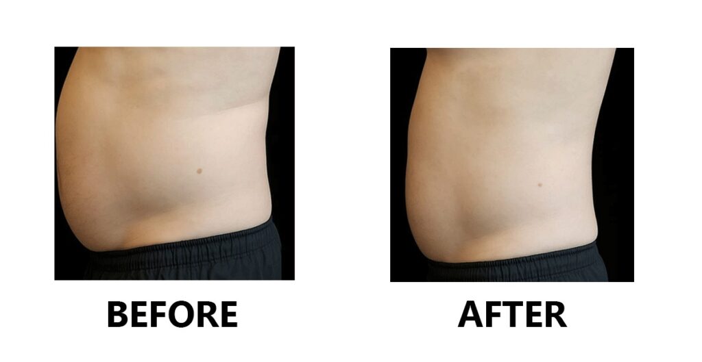Before and after photos showcasing a person's stomach transformation from Emsculpt treatment.